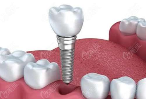 南宁种植牙多少钱一颗？2023价格区间公布了